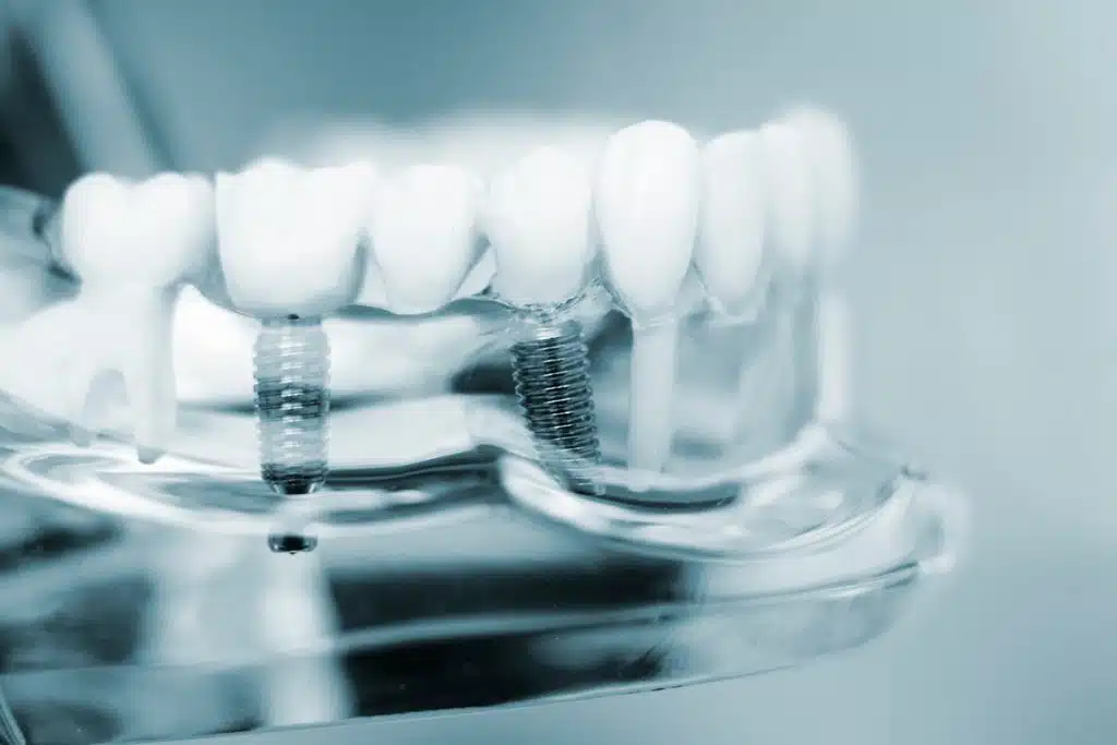 How Much Does It Cost To Get A Full Mouth Of Dental Implants?